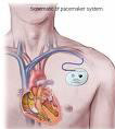 Pacemaker System